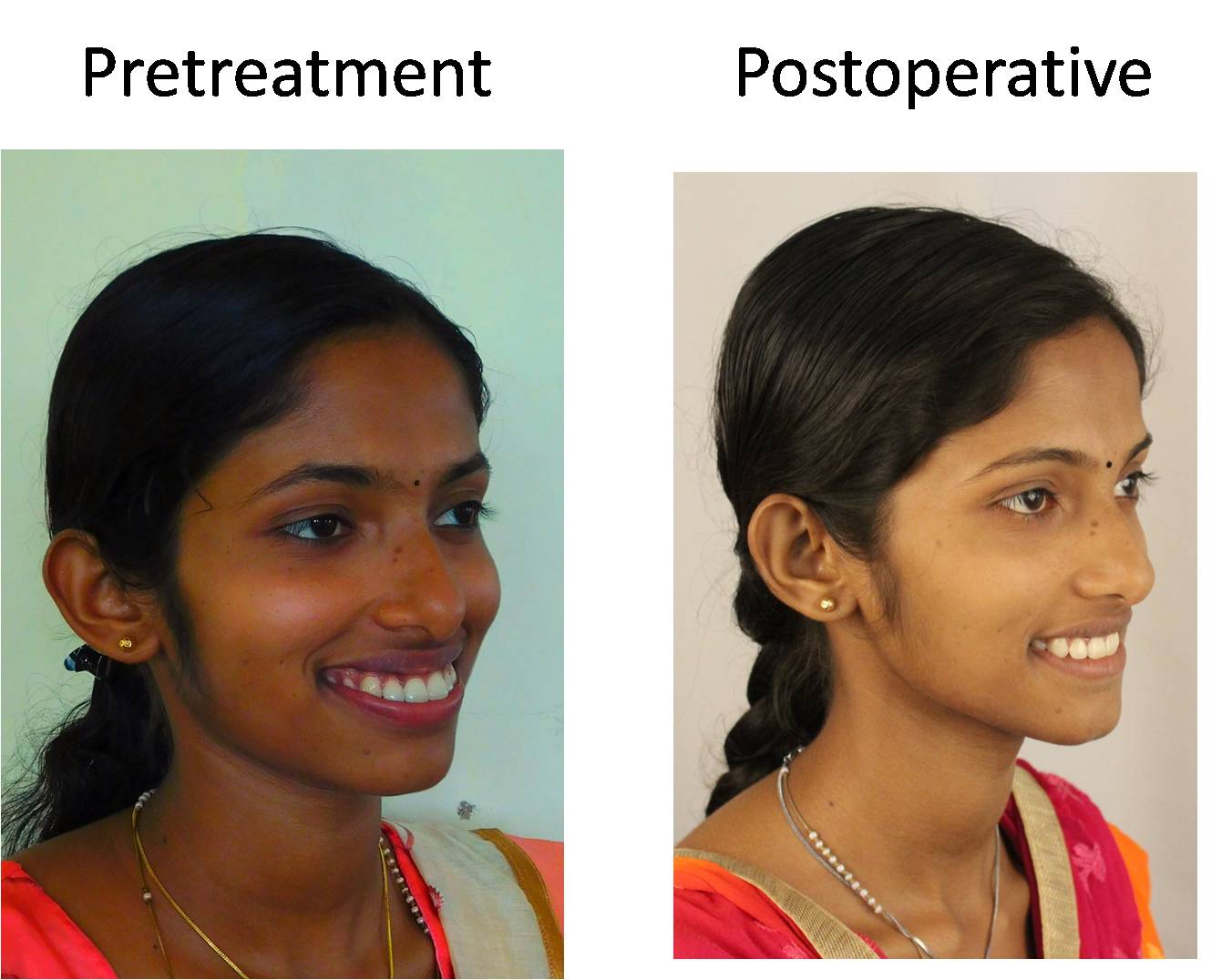 Orthodontic Treatment